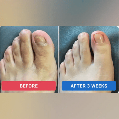 Maanufo - Fungal Nail Renewal Patches